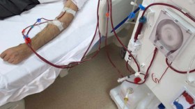 35 ألف مريض يخضعون لتصفية الدم عبر 420 مركز