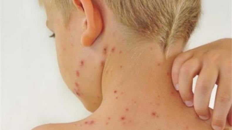 تسجيل حالات “جرب”.. وزارة الصحة تخرج عن صمتها