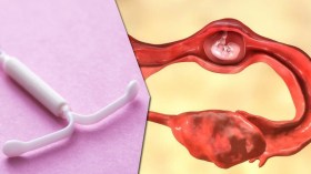 زيادة خطر حدوث حمل خارج الرحم بسبب اللولب الهرموني