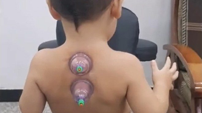 حجامة جافة وفوط نارية على أجسام الرضع…!