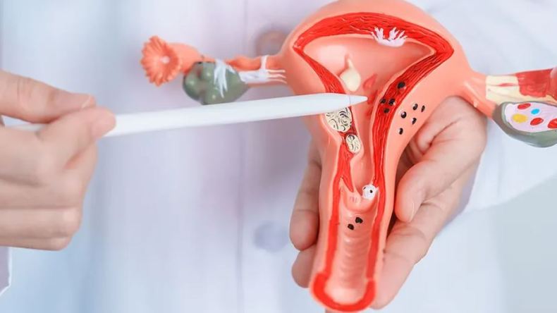 بطانة الرحم المهاجرة… مرض صامت يؤثر على حياة المرأة