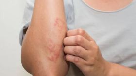 يوم تحسيسي لاكتساب مهارات التعايش مع الإكزيما التأتبية