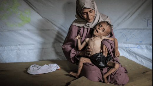 466 وفاة جراء سوء التغذية منذ 2024 في غزة