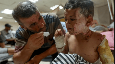 قيود الاحتلال توقف إنتاج أقنعة علاج الحروق في غزة