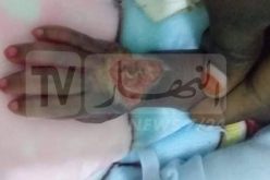 بالصور .. خطأ طبي يتسبب في تعفن يد طفل لا يتجاوز عمره 25 يوم بتمنراست
