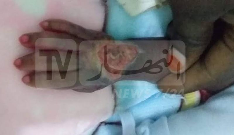 بالصور .. خطأ طبي يتسبب في تعفن يد طفل لا يتجاوز عمره 25 يوم بتمنراست