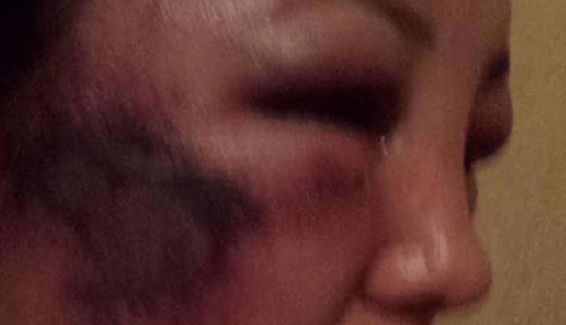 تيزي وزو : شاب يشوّه وجه شقيقته المحامية ويتسبب لها في جروح خطيرة