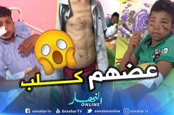 بالصور.. كلب مسعور يهاجم 3 اطفال ويدخلهم المستشفى بوهران