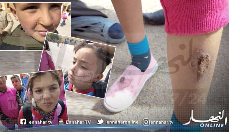 بالفيديو والصور.. إنتشار مرض الليشمانيوز وسط السكان وخاصة الأطفال في الوادي