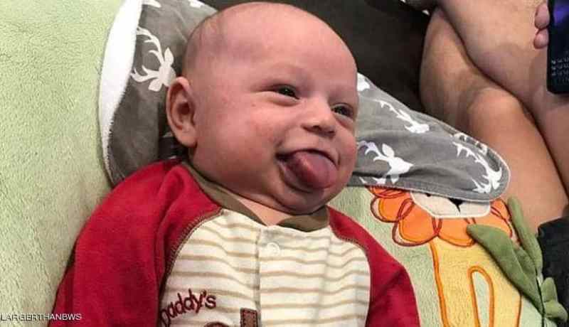 حالة طبية نادرة في أمريكا.. لسان رضيع ينمو بلا توقف