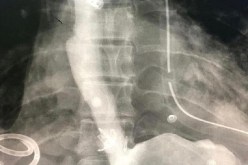 إنقاذ حياة معتمرة جزائرية من تمزق المريء بمكة