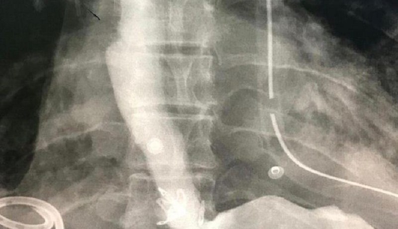 إنقاذ حياة معتمرة جزائرية من تمزق المريء بمكة