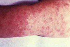 ليبيا: تسجيل حالتي وفاة و6إصابات بمرض “ريكتسيا” البكتيري