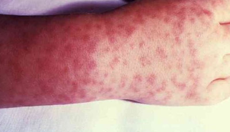 ليبيا: تسجيل حالتي وفاة و6إصابات بمرض “ريكتسيا” البكتيري