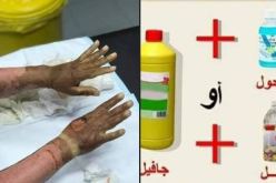 يتسبب استخدامها بحروق بليغة.. الحماية المدنية تحذر من المعقمات المنزلية