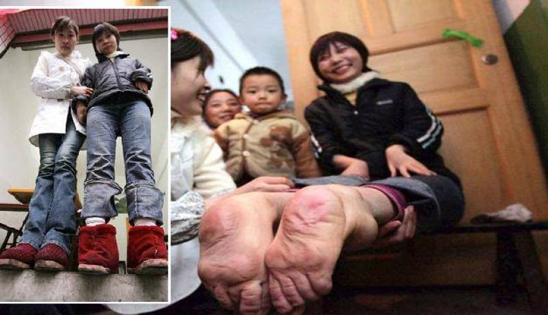 صينية بقدمين ويدين مقلوبتين تعيش حياة طبيعية