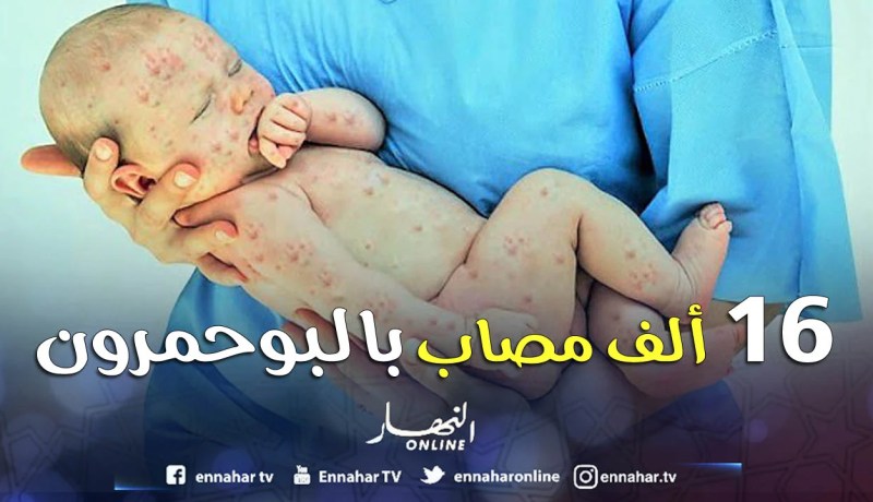 «16 ألف حالة إصابة بالبوحمرون منذ بداية السنة»
