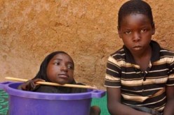 بالصور .. وفاة الفتاة رحمة التي قضت حياتها في وعاء بلاستيك