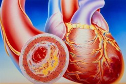 انتخاب الدكتور اسماعيل كنزوة رئيسا للفيدرالية الوطنية لجمعيات المصابين بمرض تصلب الشرايين اللويحي