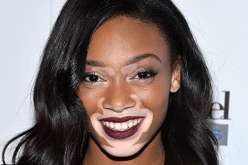 بالصور عارضة أزياء مشوهة تغير مفهوم الجمال عند البنات