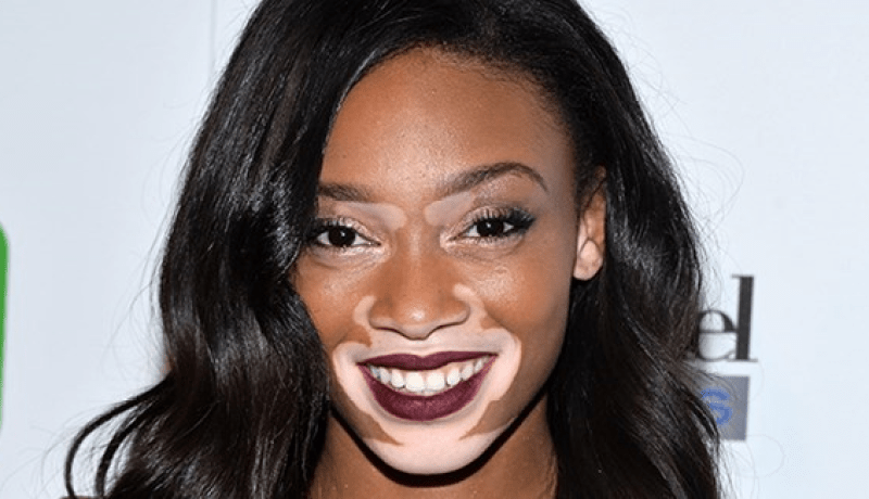 بالصور عارضة أزياء مشوهة تغير مفهوم الجمال عند البنات