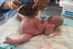 ولادة نادرة لتوأم سيامي “أنثى” في غزة