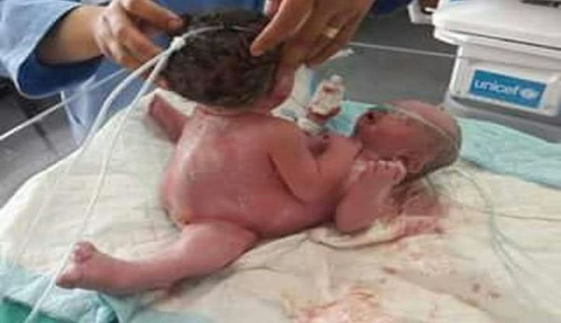 ولادة نادرة لتوأم سيامي “أنثى” في غزة