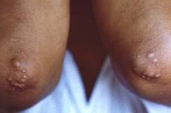 بعض خلايا جهاز المناعة قادرة على محاربة الأورام