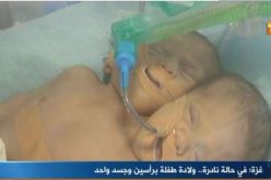 بالفيديو.. في حالة نادرة ولادة توأم سيامي في قطاع غزّة