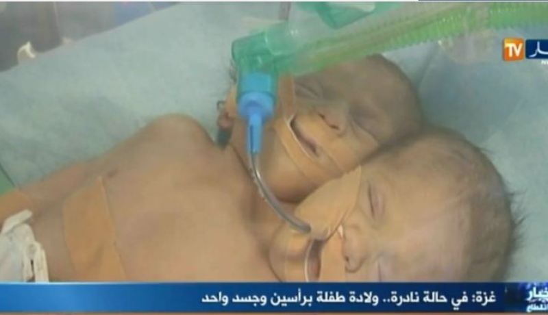 بالفيديو.. في حالة نادرة ولادة توأم سيامي في قطاع غزّة