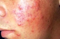 مرض جلدي معدي غريب ينتشر في حاسي مسعود