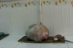 بالفيديو: استئصال ورم وزنه 15 كيلوغرام في تلمسان