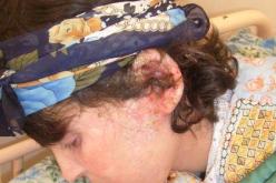 “فهيمة” عزلتها عائلتها في براكة بسبب رائحة جسدها الكريهة الذي يتفتت كالدقيق