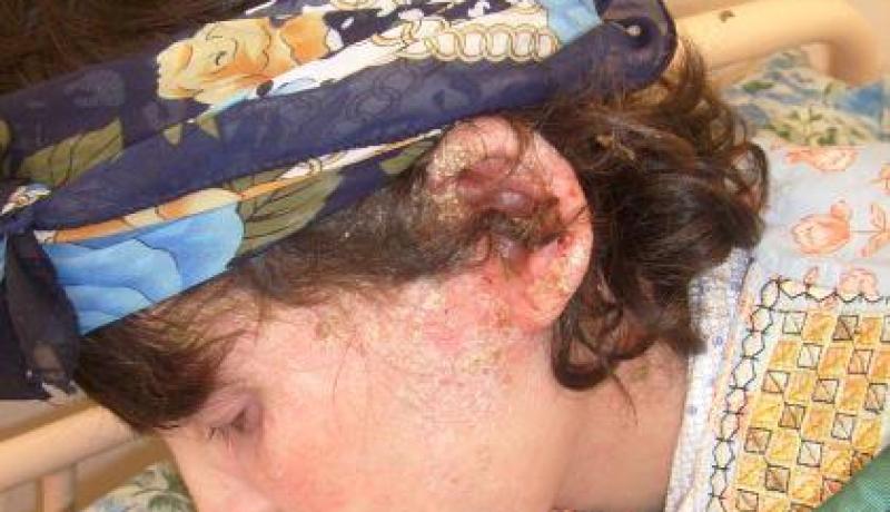 “فهيمة” عزلتها عائلتها في براكة بسبب رائحة جسدها الكريهة الذي يتفتت كالدقيق