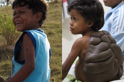 جراح بريطاني تكفل بعلاج “طفل السلحفاة” مجانا