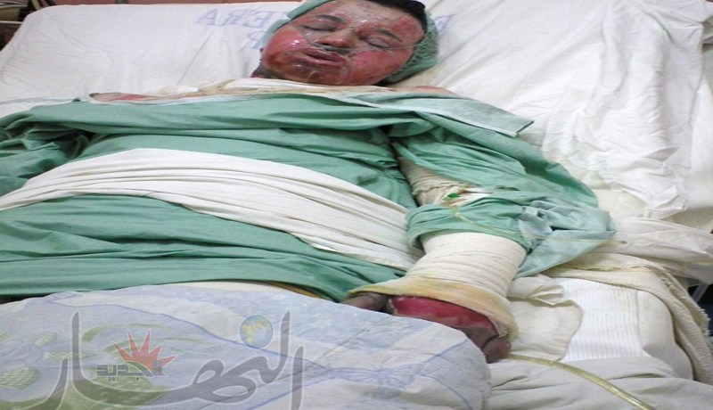  الطالب الذي أحرق نفسه في تيارت في حالة خطيرة