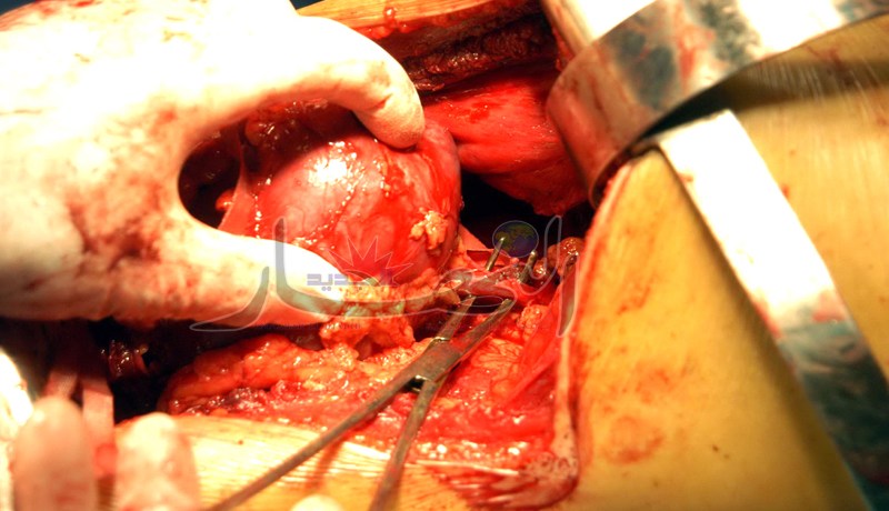 ''كـلى'' فرنسية للحصـول على بطاقة الإقـامة.. !