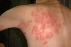 أكثر من 200 حالة إصابة بداء بوشوكة في ظرف ثلاثة أشهـر