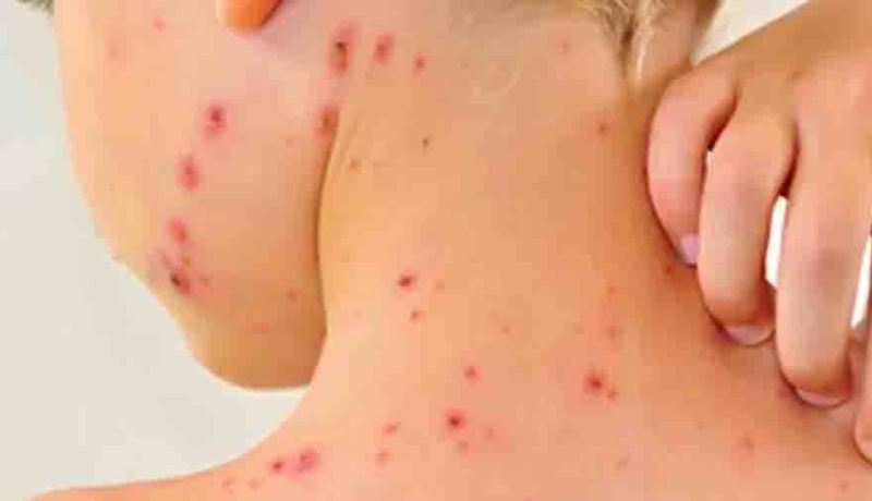 وباء بوحمرون يضرب في تبسة وإصابة 12 تلميذا في الشريعة