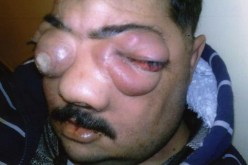 رب عائلة يستنجد بالوالي والوزير زياري لإنقاذه من مرض خبيث وغريب ينهش وجهه