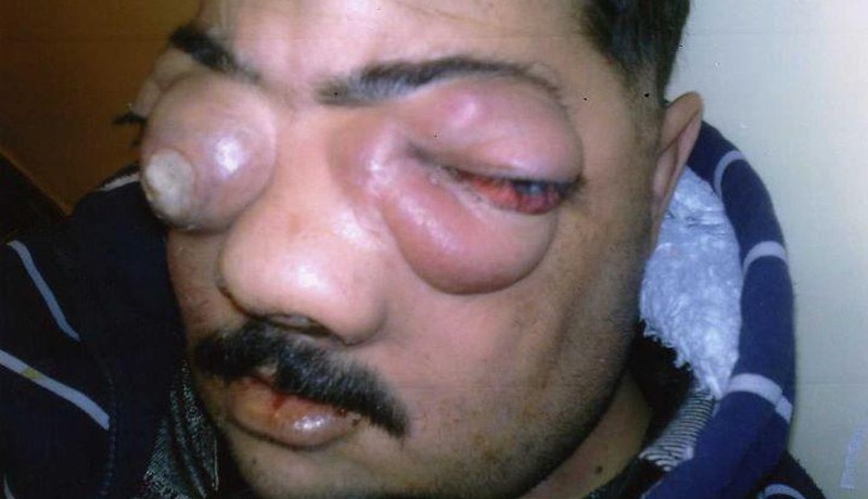 رب عائلة يستنجد بالوالي والوزير زياري لإنقاذه من مرض خبيث وغريب ينهش وجهه