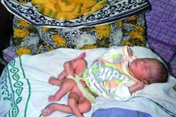 عملية جراحية ناجحة لطفل باكستاني‮ ‬ولد بـ 6 ‬أرجل