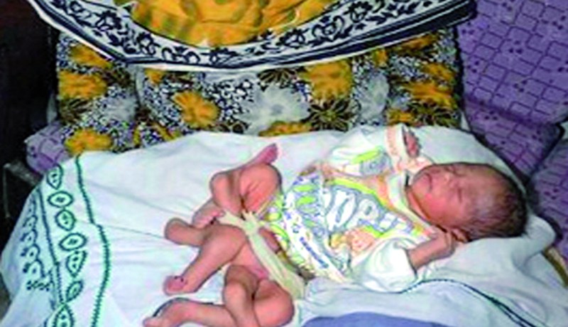 عملية جراحية ناجحة لطفل باكستاني‮ ‬ولد بـ 6 ‬أرجل