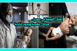 فيديو.. أطفال الغوطة الشرقية أشبه بهياكل عظمية