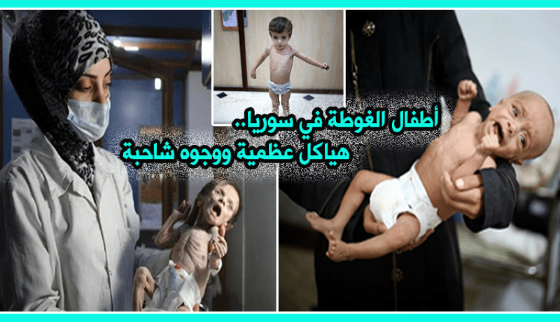 فيديو.. أطفال الغوطة الشرقية أشبه بهياكل عظمية