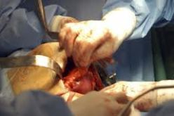 تأجيل أولى عمليات زرع الكلى بباتنة لبضعة أيام