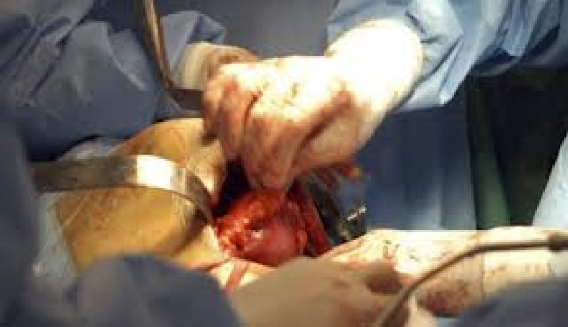 تأجيل أولى عمليات زرع الكلى بباتنة لبضعة أيام