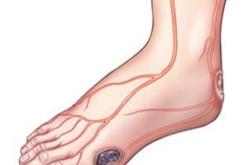 15 بالمائة من المصابين بداء السكري يتعرض قدمهم إلى الإصابة بتقرحات