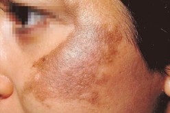 ثلث النساء البالغات 40 سنة فما فوق يعانين من ظهور بقع بنية على الوجه واليدين