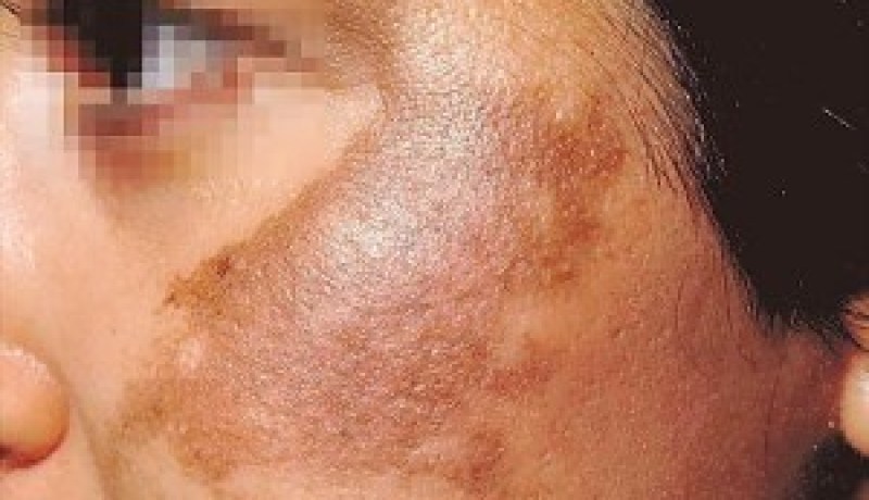ثلث النساء البالغات 40 سنة فما فوق يعانين من ظهور بقع بنية على الوجه واليدين